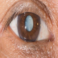 白内障高发人群大揭秘：这些人需格外警惕！