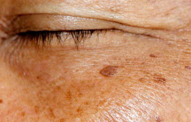 熬夜与黄褐斑：夜间“暗斑加速器”的真相揭秘