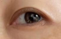 全切双眼皮术后如何应对社交压力？三步化解焦虑，拥抱自信社交