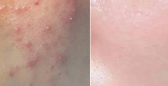 痘痘肌清洁秘籍：温和洁面，告别“痘”扰