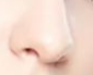 鼻头矫正术后：鼻头会“反弹”吗？
