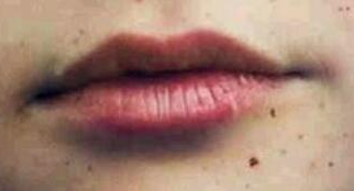 雀斑“偏爱”的肌肤区域：紫外线暴露下的高发地图