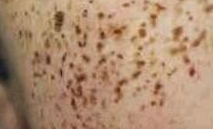 雀斑形状全解析：圆形、卵圆形与不规则形的独立美学