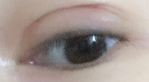 双眼皮术后效果不满意？科学修复指南助你重拾自信