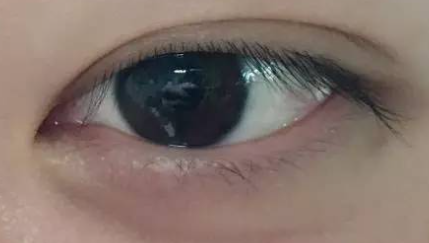 双眼皮术后墨镜使用实录：3个真实案例揭秘安全佩戴法则