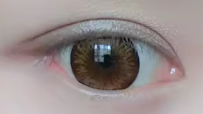 双眼皮术后低头陷阱全解析：1周黄金期避坑指南