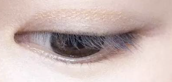 双眼皮手术与提眉术能否“强强联合”？科学解析联合手术的真相与风险-55804