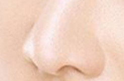 鼻炎患者能否进行鼻头矫正？科学解析手术时机与注意事项