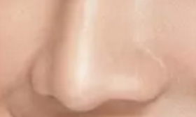 鼻炎患者做鼻头矫正必看！避开这些坑才能安全变美