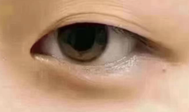 双眼皮与眼袋手术能否