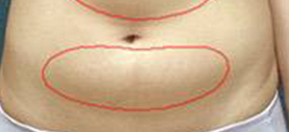 吸脂术后塑身衣避坑指南：别让“美丽捷径”变“健康陷阱”