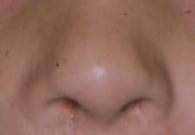 疤痕体质者能否进行鼻头矫正手术？需谨慎评估风险与收益