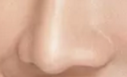 探店实录｜鼻头矫正术后