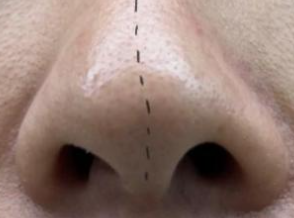 探店实录：疤痕体质能否做鼻头矫正手术？专业医生揭秘风险与真相