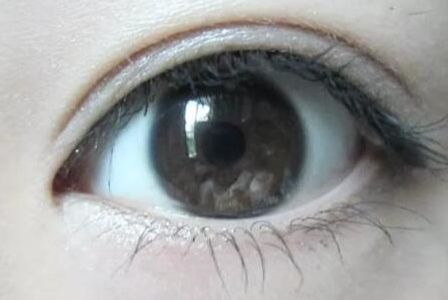 双眼皮术后激光美容：1个月“安全期”背后的真相与科学指南