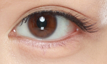 埋线双眼皮避坑指南：这3个误区让你“无痕变有痕”！-55846