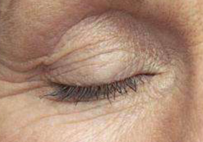 注射除皱术后护理指南：洗头时间与注意事项解析