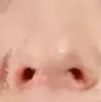 鼻头矫正术后怀孕时间实测：3-6个月是关键期，全麻代谢需警惕！