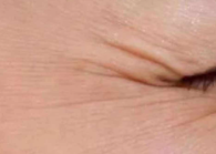 注射美容后护理指南：刷牙这件小事也有大学问