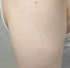 埋线双眼皮术后消肿秘籍：科学护理加速美丽蜕变