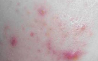 痘痘肌敷面膜科学指南：频率、成分与手法全解析-55910