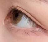 埋线双眼皮防感染避坑指南：这3个雷区踩中一个，恢复期就毁了！