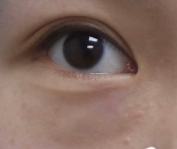 眼袋大小与衰老关系大揭秘：并非越大衰老越严重