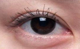 埋线双眼皮效果持久性揭秘：一般维持2-5年，个体差异显著