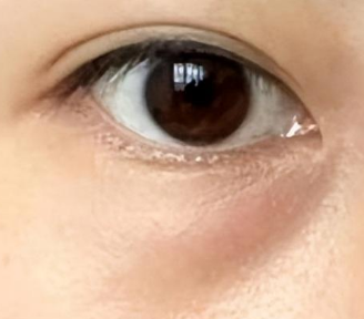 眼袋越大越显老？避开这3个误区，科学认识眼袋与衰老的关系