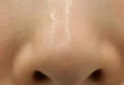探秘鼻翼矫正术：解锁多种鼻翼畸形的修复密码