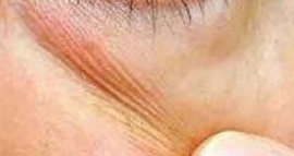 国外去眼袋技术更“神”？微创与个性化才是关键差异