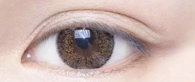 双眼皮脱落莫慌张，科学修复有良方