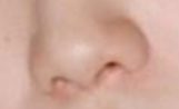 复杂鼻翼矫正避坑指南：分阶段手术与鼻模塑形的真相-56016