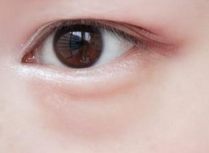 国内外去眼袋技术测评：微创与个性化成国际“加分项”