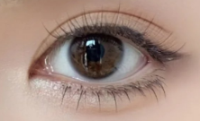 埋线双眼皮VS三点定位双眼皮：如何选择最适合你的