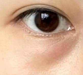 韩国眼袋手术：自然美学与整体设计的完美融合