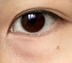 探秘韩国眼袋手术：自然之美与整体设计的精妙融合