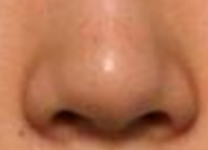 鼻翼矫正术后伤口清洁：细节决定美丽与健康