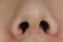 鼻翼矫正术后复查全攻略：科学管理恢复周期，远离并发症风险