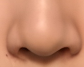 探秘鼻翼矫正术后伤口清洁秘籍，守护美丽不“受伤”