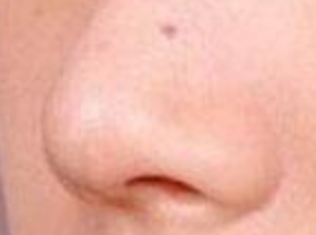 鼻翼矫正术后复查：不可忽视的美丽“护航”