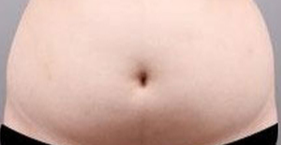 脂肪栓塞：吸脂手术中的“隐形炸弹”需警惕