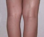 医美避坑指南：揭开脂肪栓塞的致命面纱