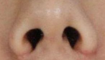 鼻翼矫正后血肿处理指南：科学应对，远离风险