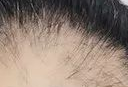 毛发种植是“永久性”的吗？揭秘毛囊移植的真相与长期效果