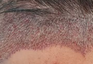 毛发种植：从“秃”到“密”的医学魔法如何实现？