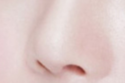 鼻翼矫正术后防感染全攻略：科学护理助你安心恢复