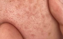 药物与雀斑的隐秘关联：这些“元凶”需警惕-56138