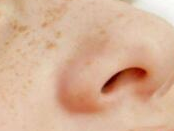 皮肤屏障受损=雀斑“加速器”？过度清洁正在让你离无瑕肌越来越远！-56142