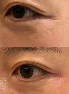 眼周衰老全解析：六大表现揭示眼部年轻密码-56155